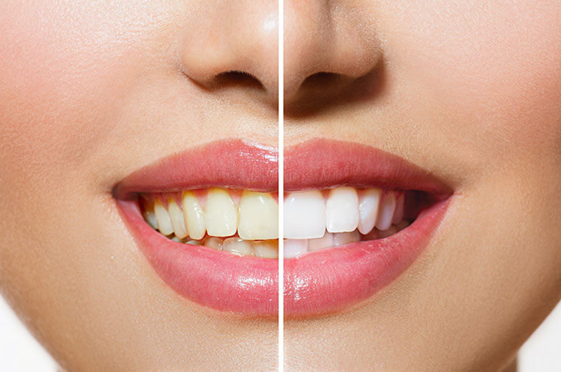 Is whitening your teeth with hydrogen peroxide safe